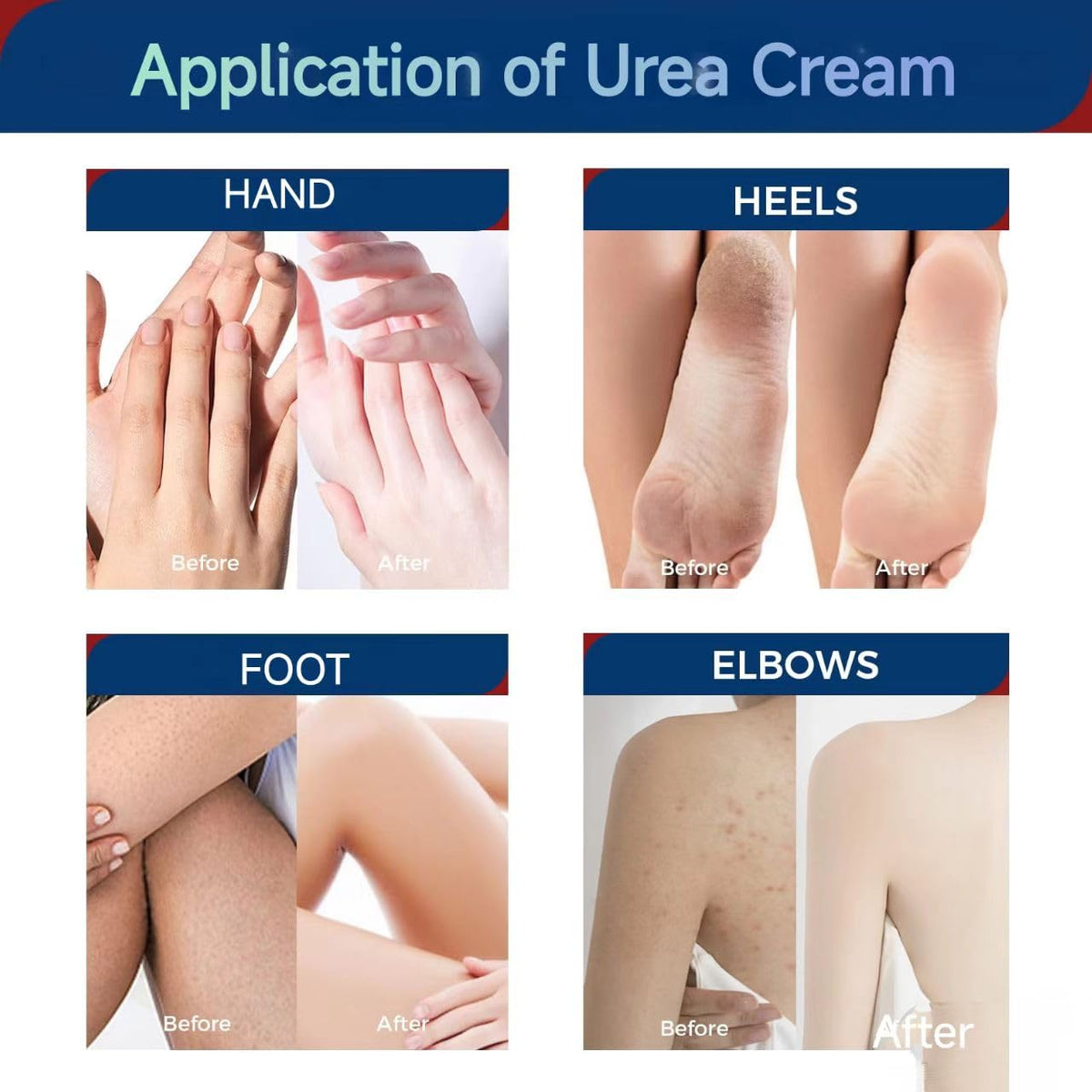 OUKEYA label closeup highlighting urea and salicylic acid ingredients benefit