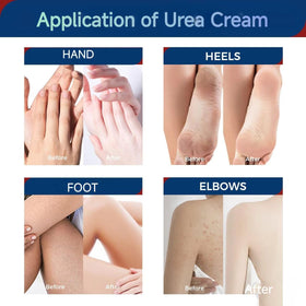 OUKEYA label closeup highlighting urea and salicylic acid ingredients benefit