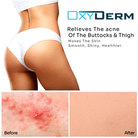 oxyderm ingredients label highlighting salicylic glycolic and lactic acids