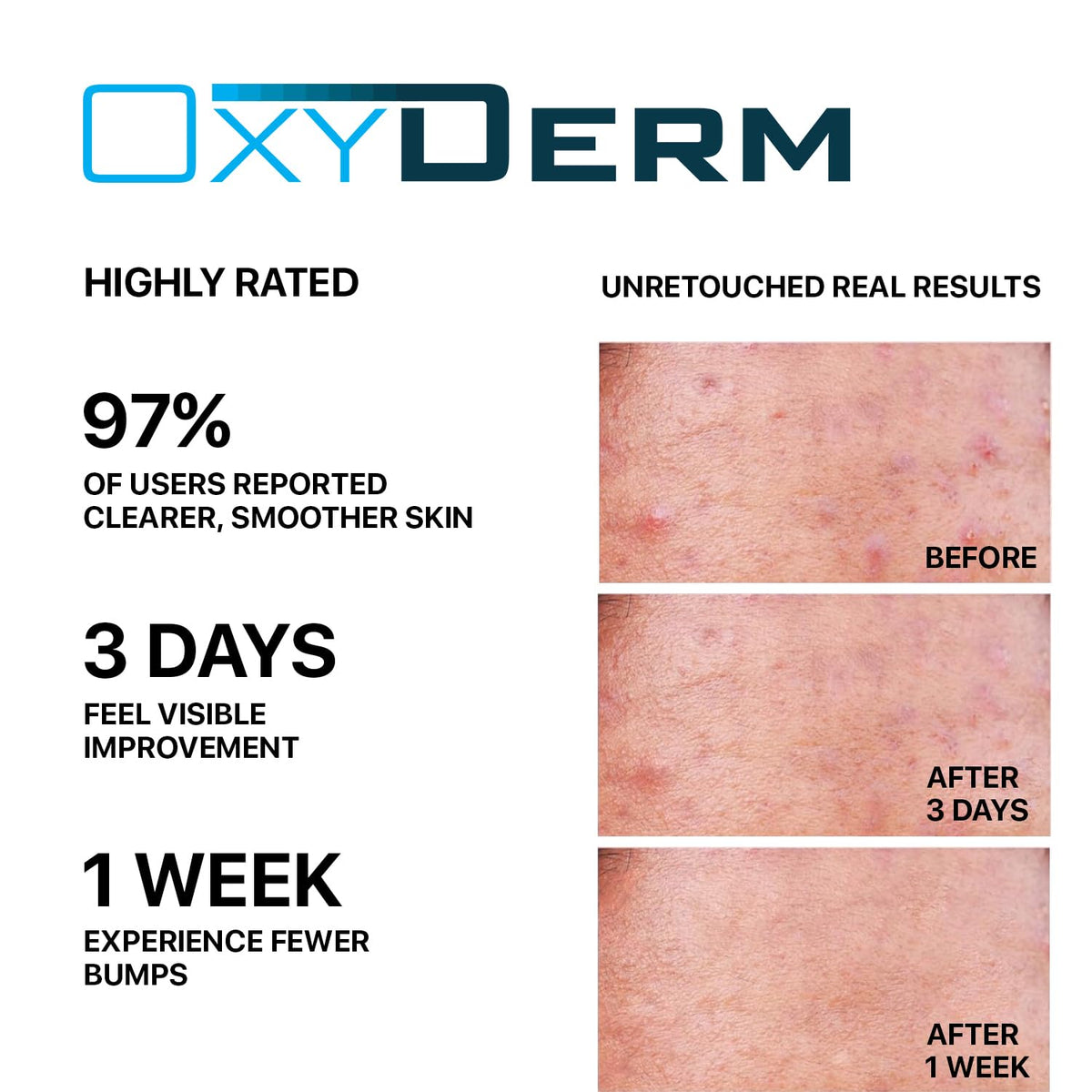 oxyderm pad in hand ready to apply for convenient spot treatment