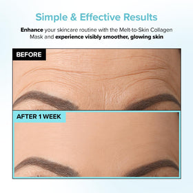 PAIGED smile-line patch placed beside mouth reducing crease appearance