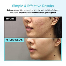 PAIGED under-eye patch application showing delicate area support