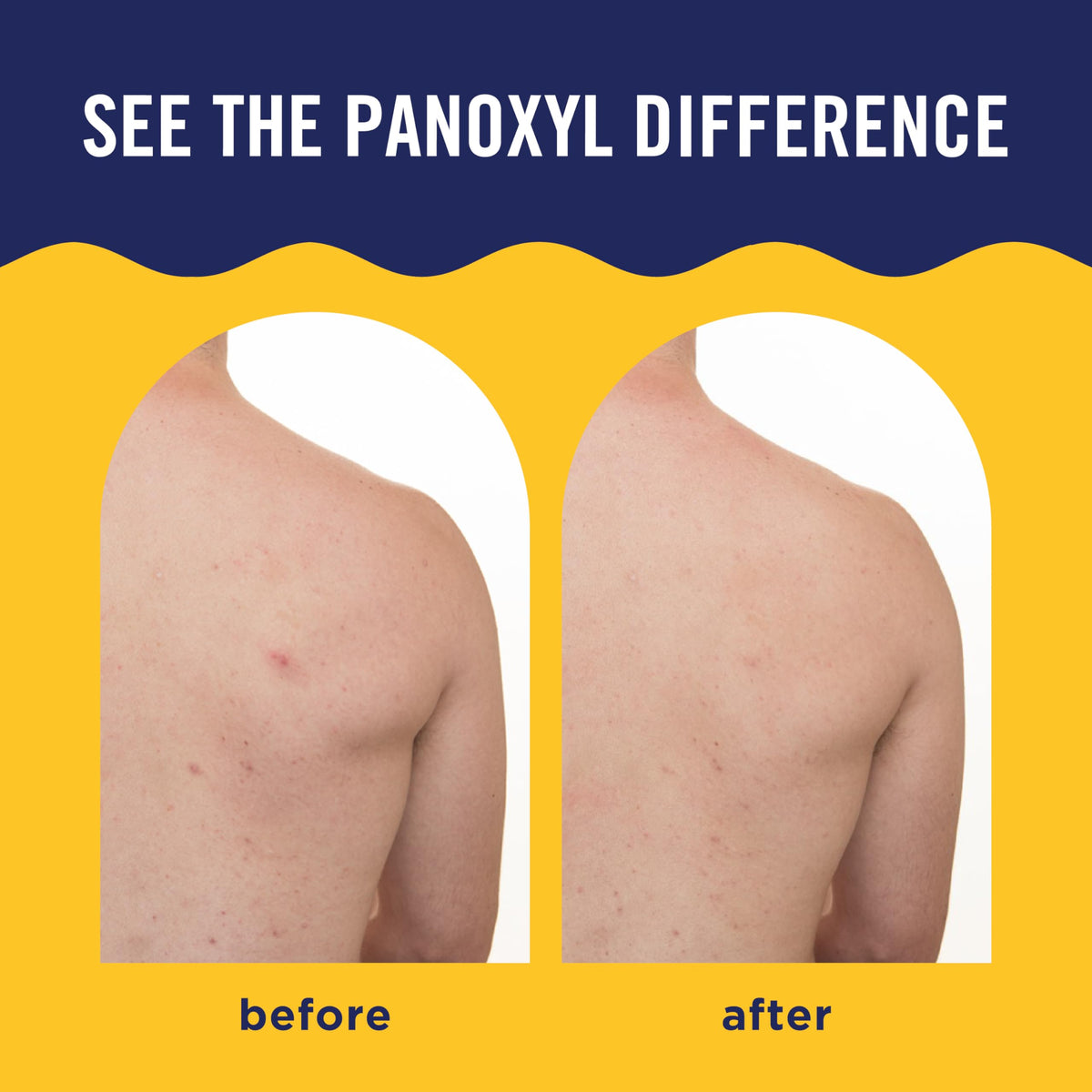 PanOxyl bottle with highlighting of niacinamide and vitamin C benefits