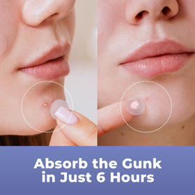 PatchRx patch on face application protecting blemish visibly