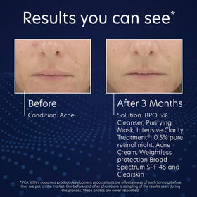 PCA SKIN application in hand demonstrating easy massage-on use and thorough cleansing