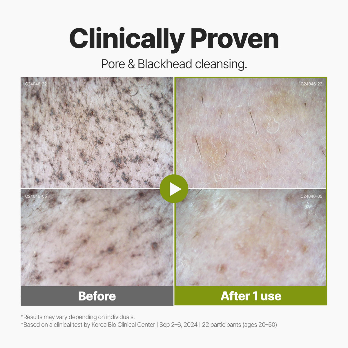 P.CALM application on nose and T-zone demonstrating targeted blackhead care