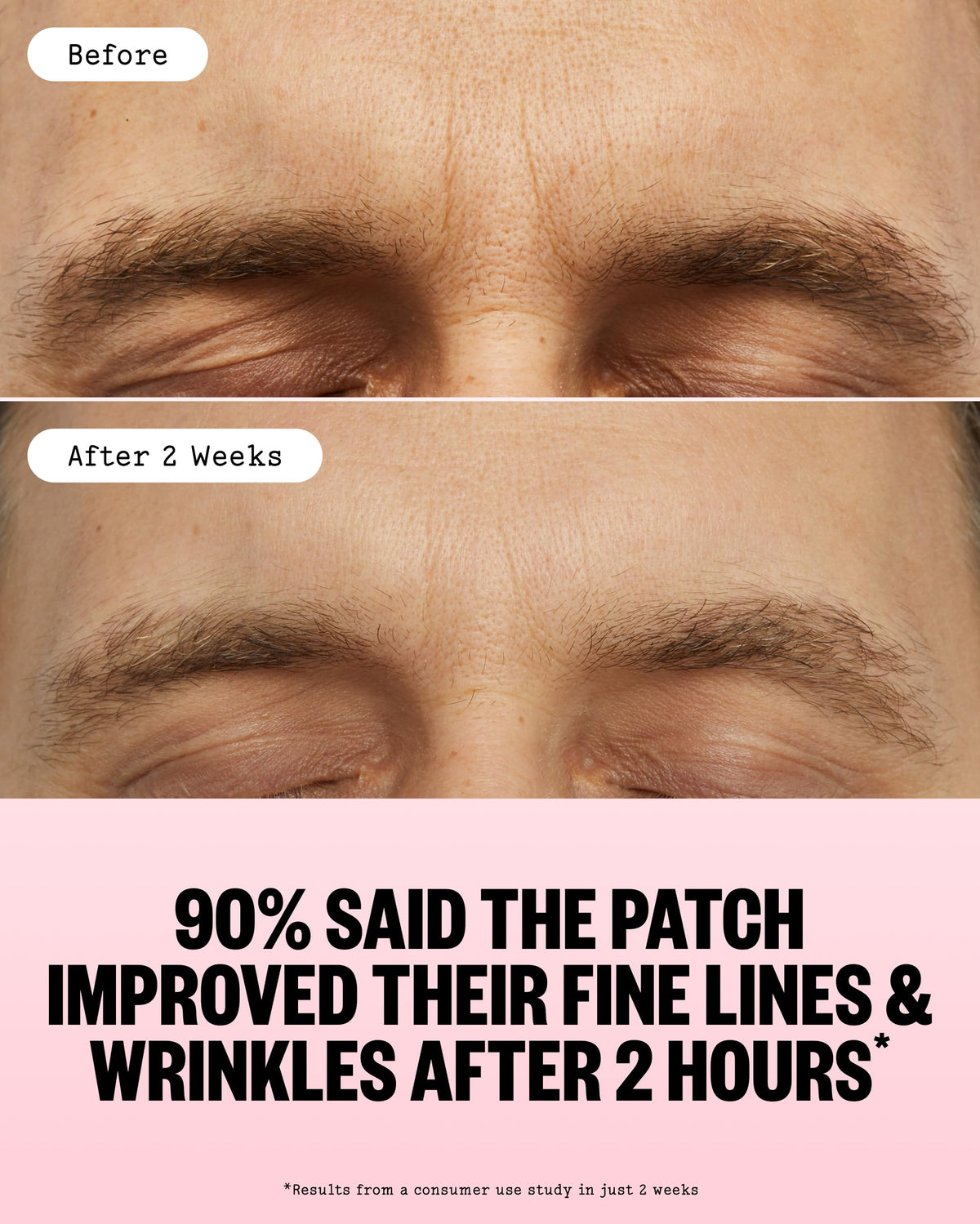 PEACE OUT needle texture with hyaluronic infusion showing immediate plumping benefit