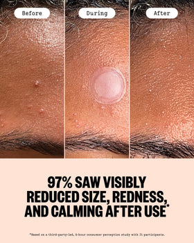 PEACE OUT patch applied to cheek demonstrating discreet coverage benefit