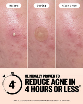 PEACE OUT dot texture under soft light highlighting thin breathable hydrocolloid benefit