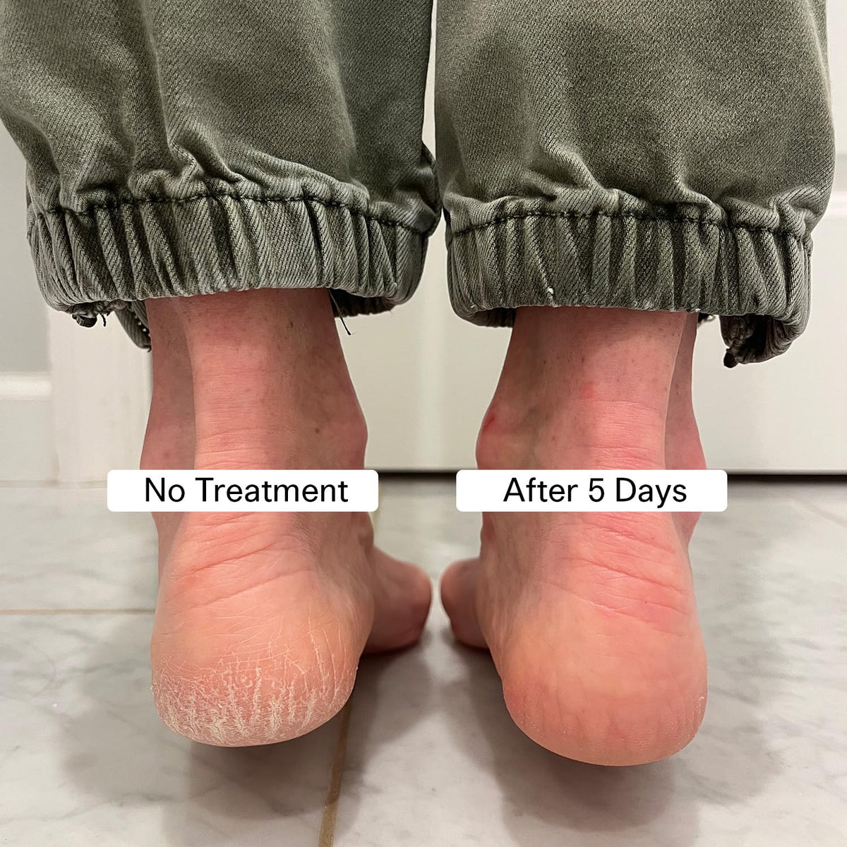 Pedestrian Project balm being applied to heel to smooth cracks quickly