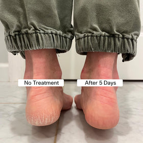 Pedestrian Project balm being applied to heel to smooth cracks quickly