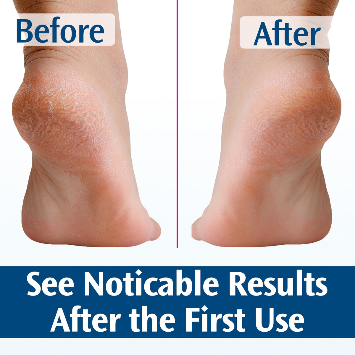 PediFix before and after foot photos showing softened heels and calluses