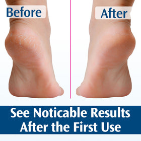 PediFix before and after foot photos showing softened heels and calluses