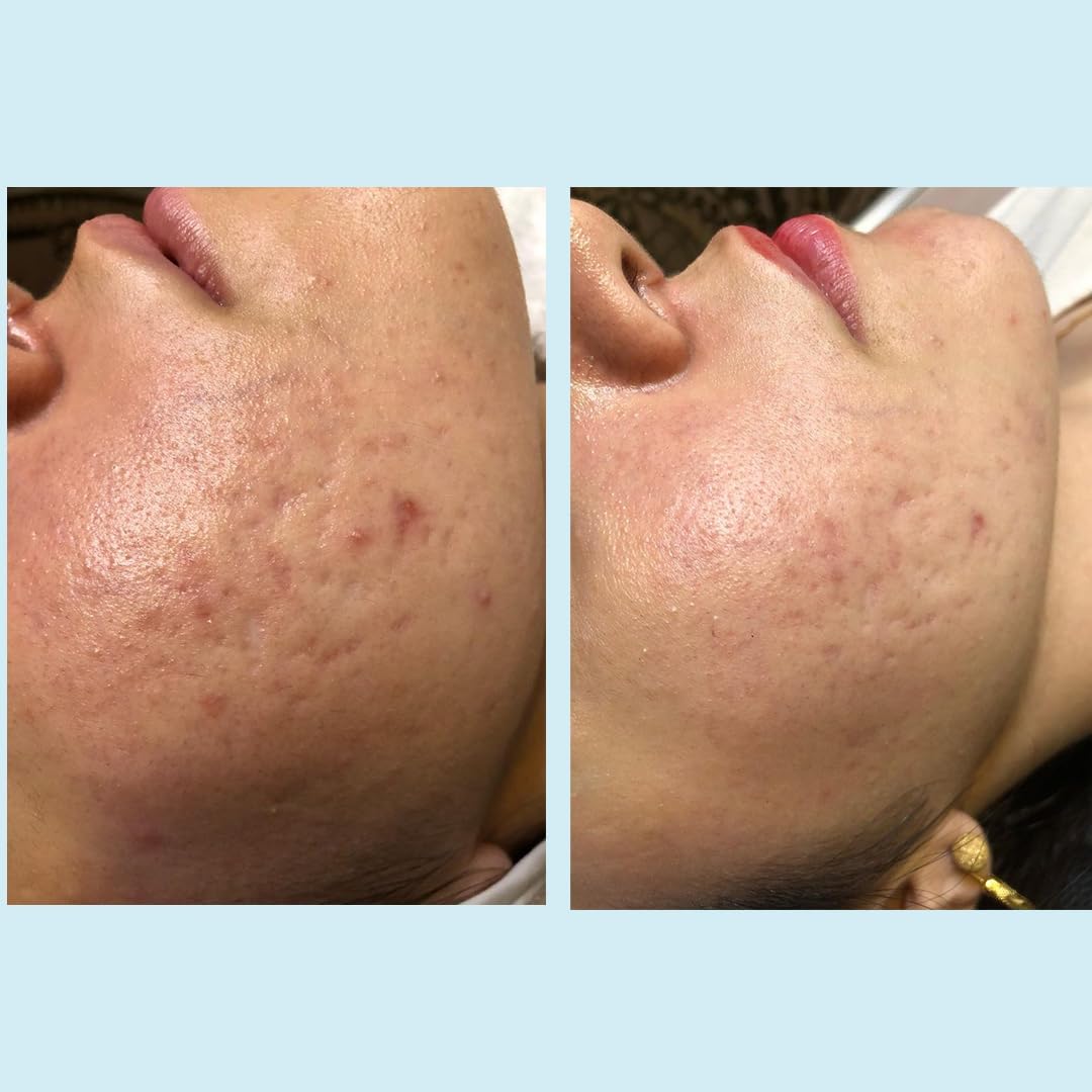 Perfect Image product next to sunscreen for scale and post-peel protection benefit