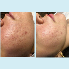 Perfect Image product next to sunscreen for scale and post-peel protection benefit