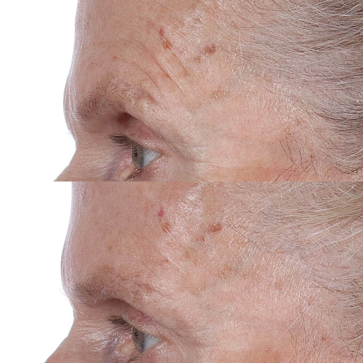 Perricone MD being applied with cotton pad to refine pores and prep skin