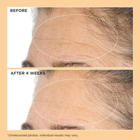 Perricone MD before and after illustration showing visible softening of deep creases