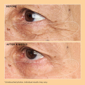 Perricone MD under-eye before and after sample illustrating visible smoothing benefit