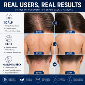 Peunitory being applied to scalp bumps demonstrating targeted spot treatment benefit