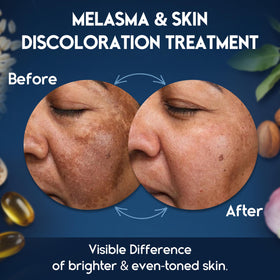 Pharmlitalia applied to cheek showing targeted coverage of dark spots