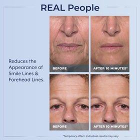 Plexaderm before and after eye area showing reduced puffiness and visible lift