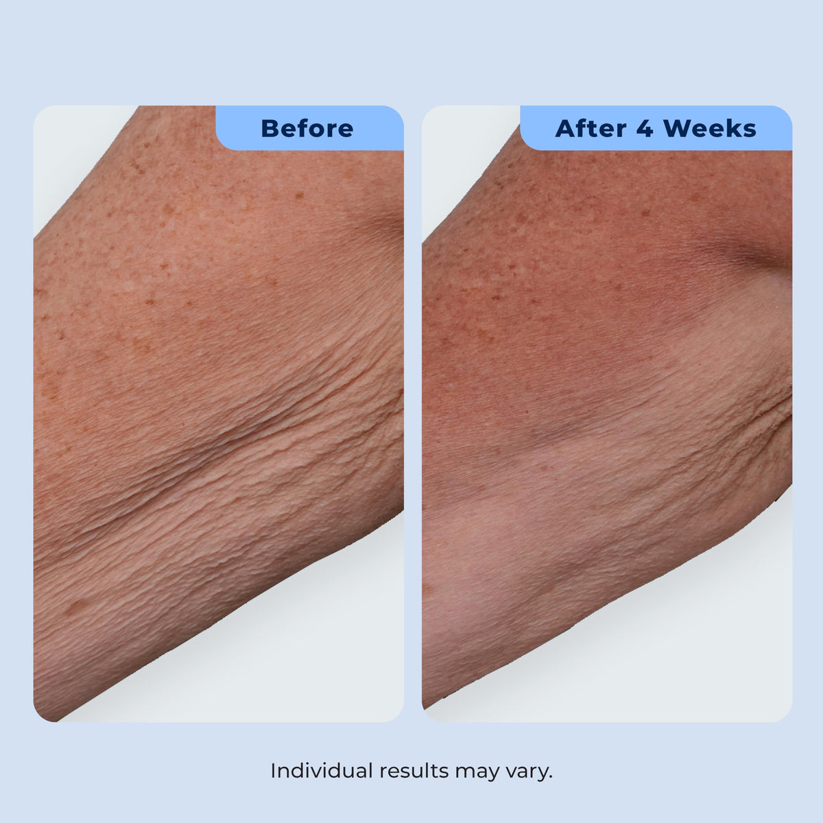 Plexaderm cream being applied to neck, targeted smoothing and hydration benefit