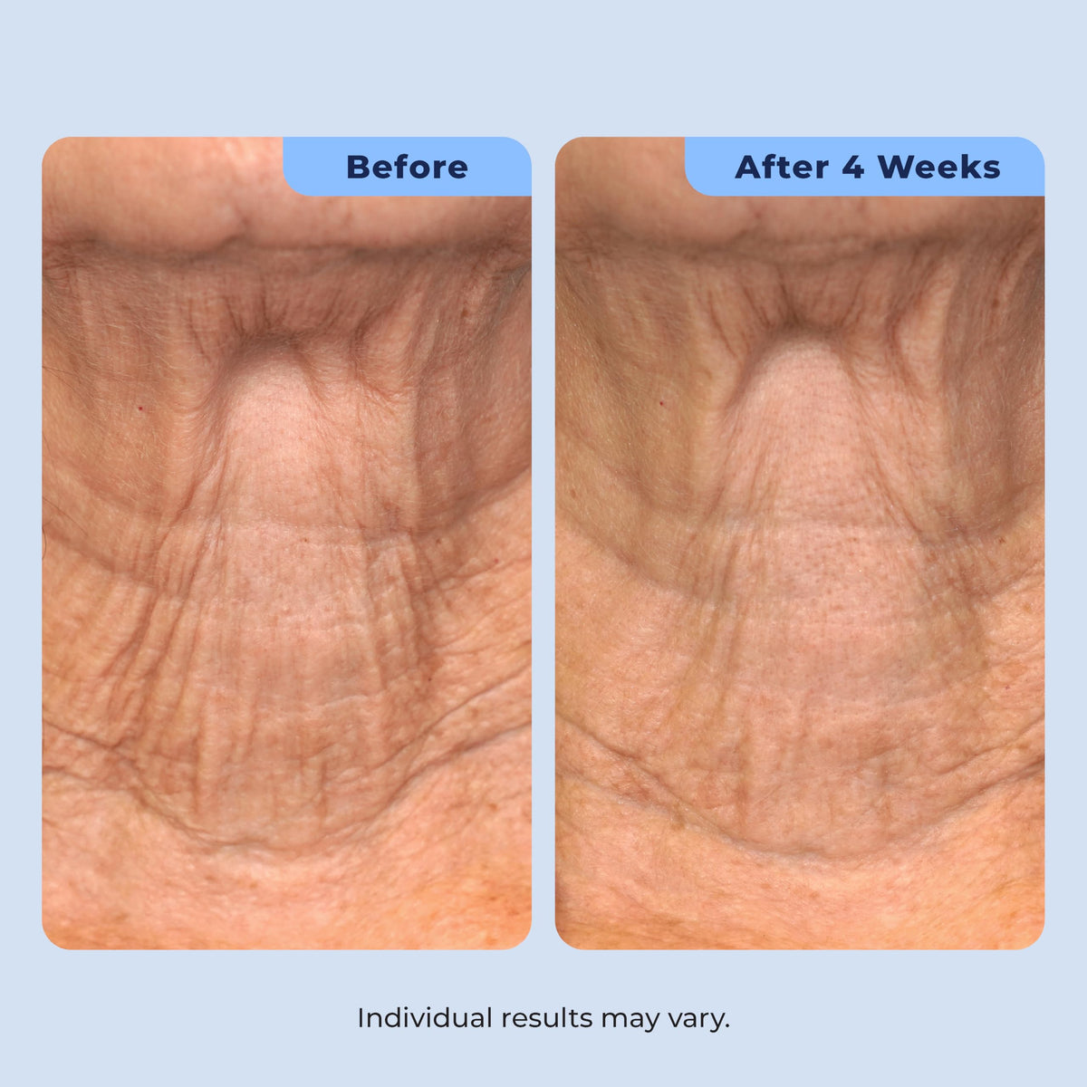 Plexaderm neck treatment shown with comparison scale, visual of improved texture