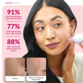 PMD Beauty kit contents laid out with multiple discs and accessories for customizable at-home microdermabrasion