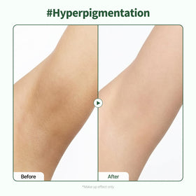 PONGDANG before and after arm comparison showing evened skin tone