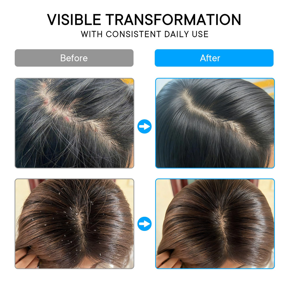 ProBliva before and after scalp visual highlighting reduced flaking benefit