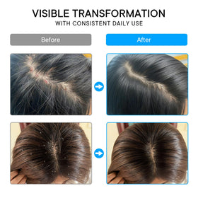 ProBliva before and after scalp visual highlighting reduced flaking benefit