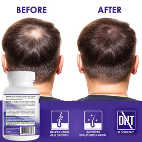 Pronexa Propidren conceptual before and after indicating fuller-looking hair