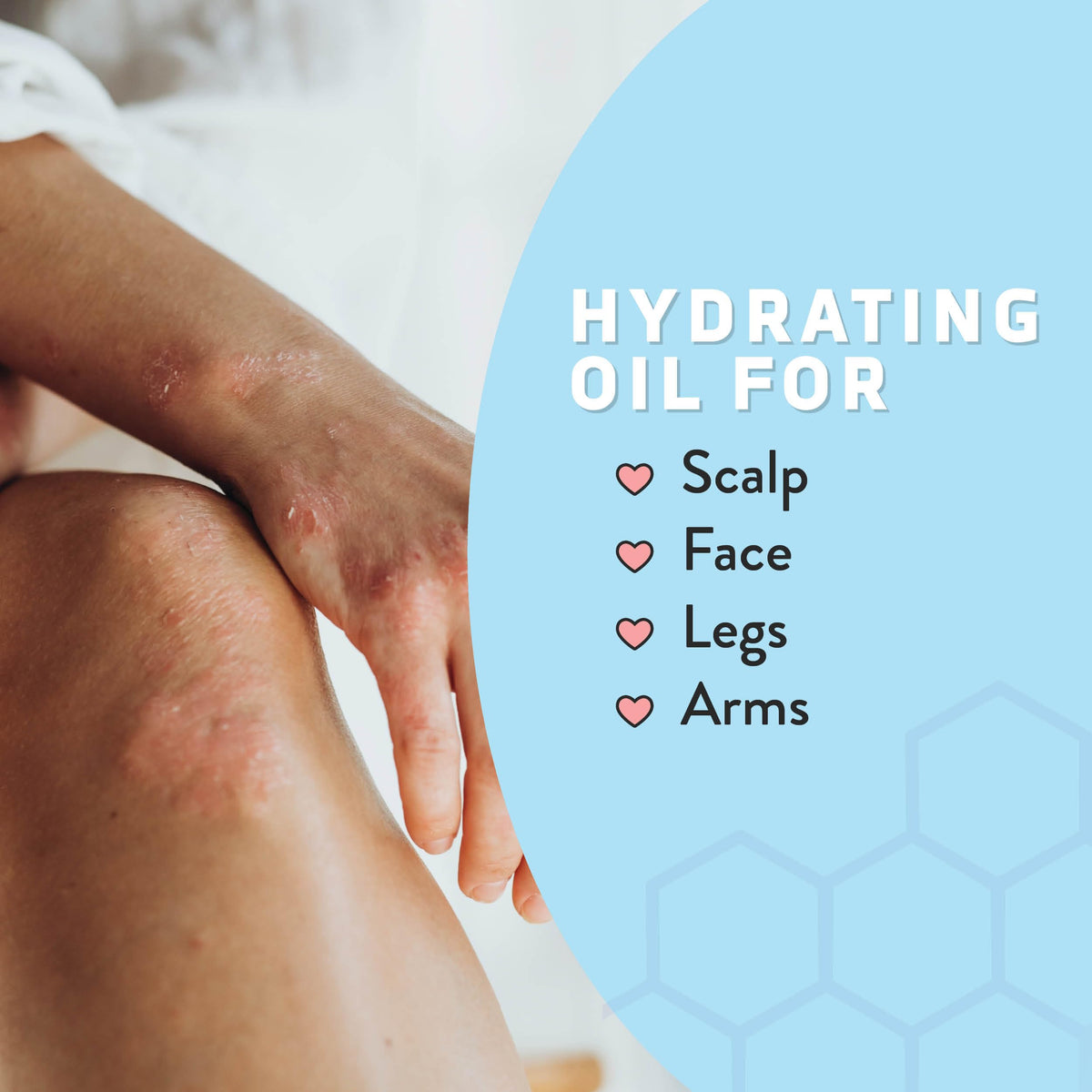 PSORIASIS HONEY scalp application image demonstrating targeted use to soothe dry scalp areas