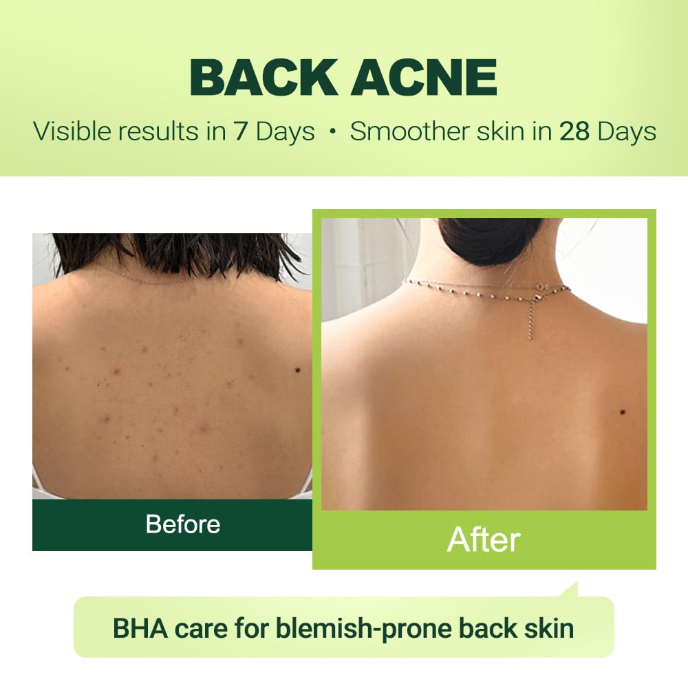 pure.tiful face use demonstration showing targeted acne treatment benefit