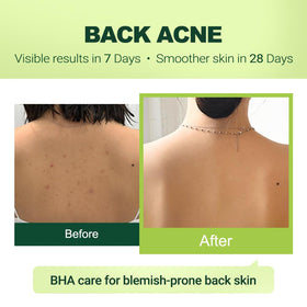 pure.tiful face use demonstration showing targeted acne treatment benefit