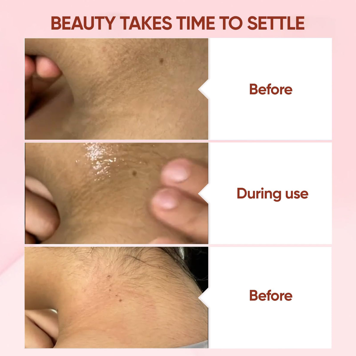 QUARXERY gel on hand demonstrating gentle peeling action for cleaner skin