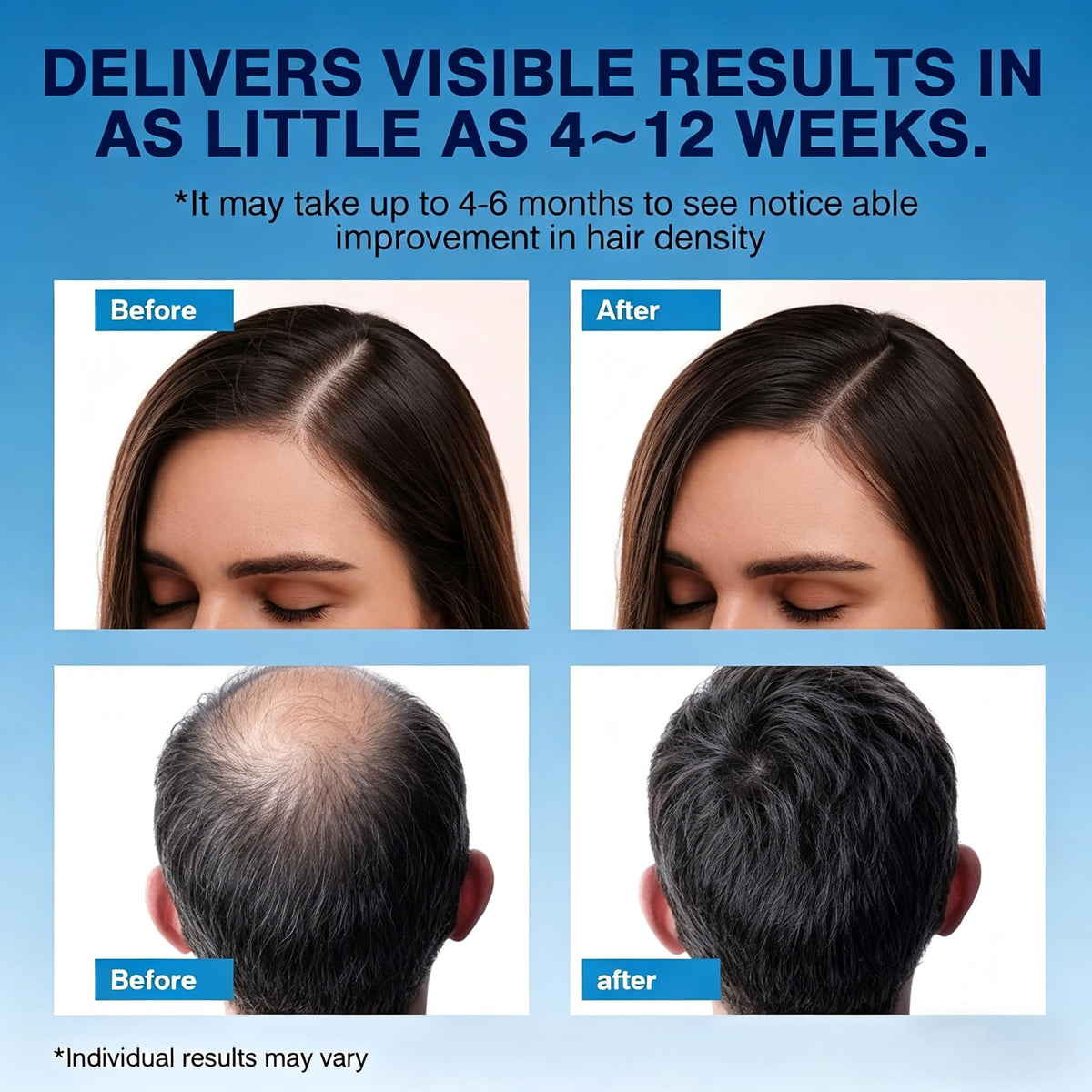 Quilom foam applied to beard area illustrating fuller facial hair potential