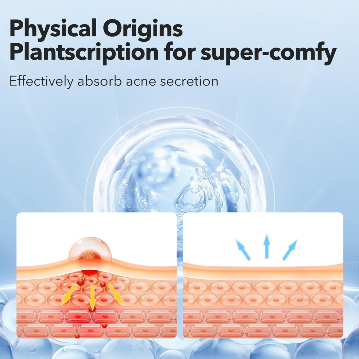QUSTERE patch applied on skin protecting a zit while reducing irritation