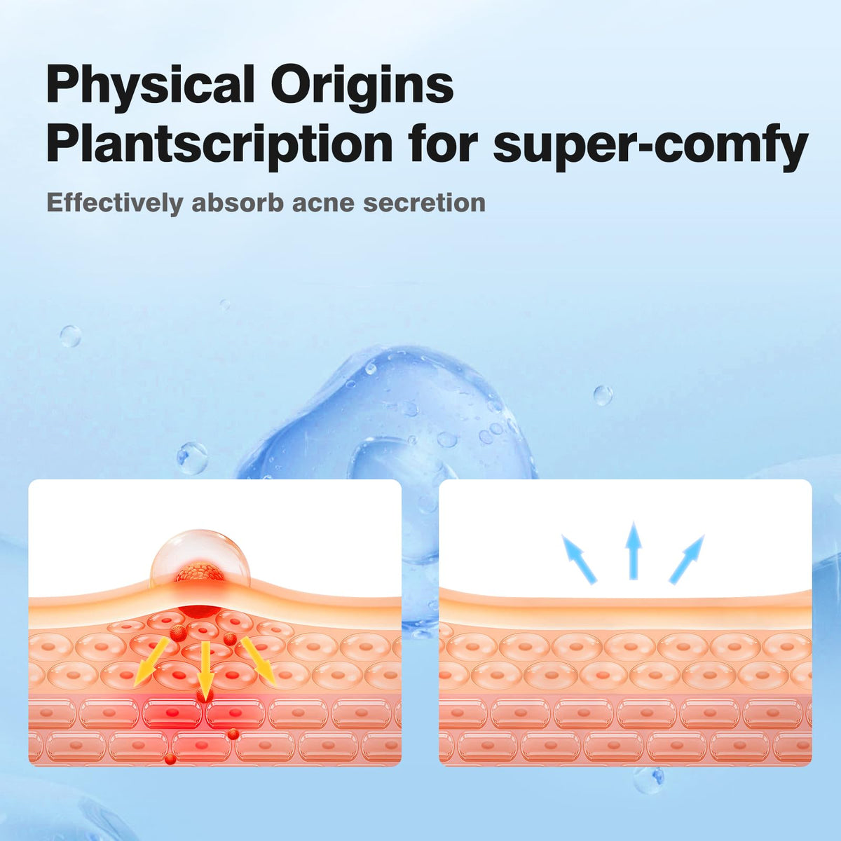 QUSTERE four-size comparison laid out to choose correct patch for each blemish