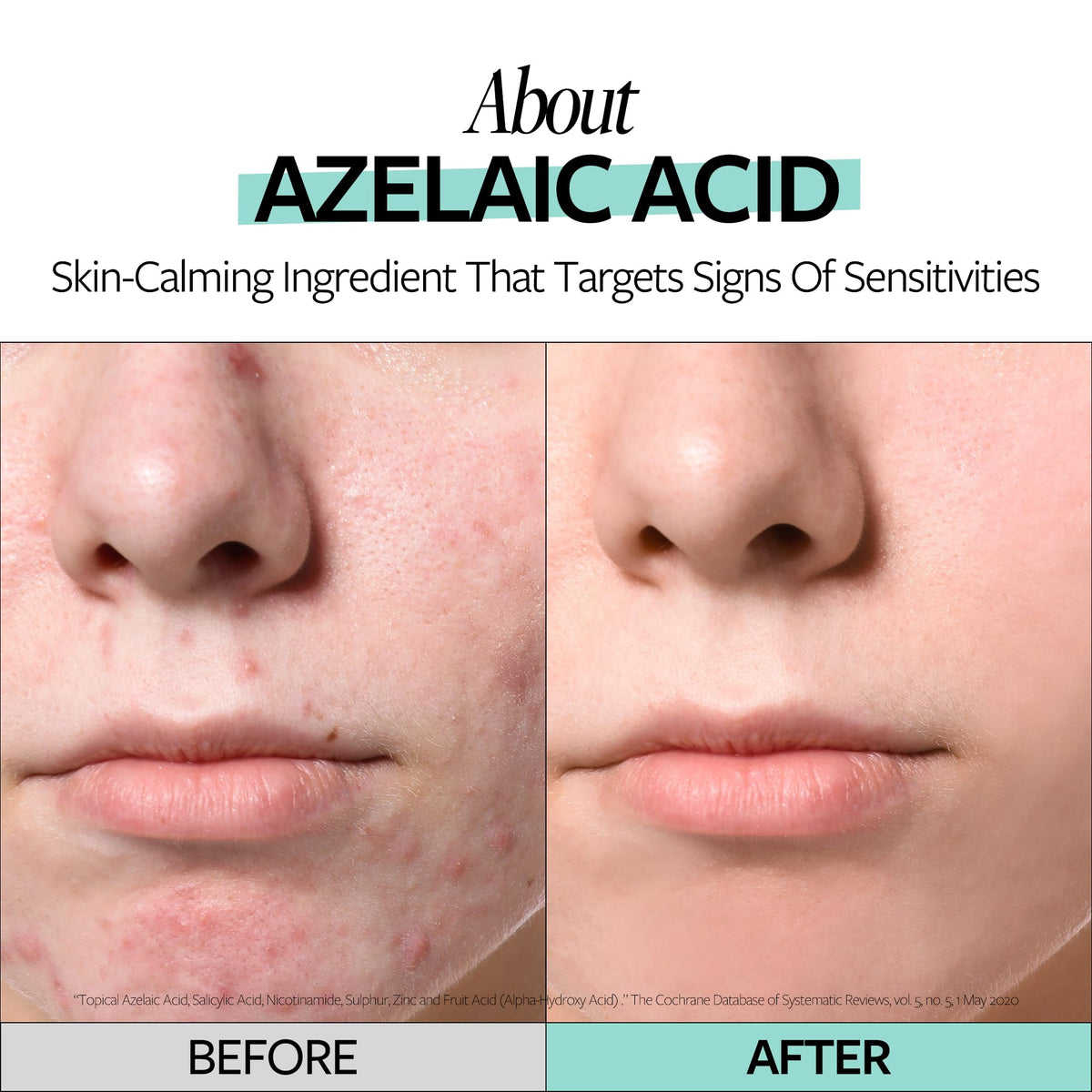 RE:CIPE ingredients label highlighting azelaic acid and soothing actives