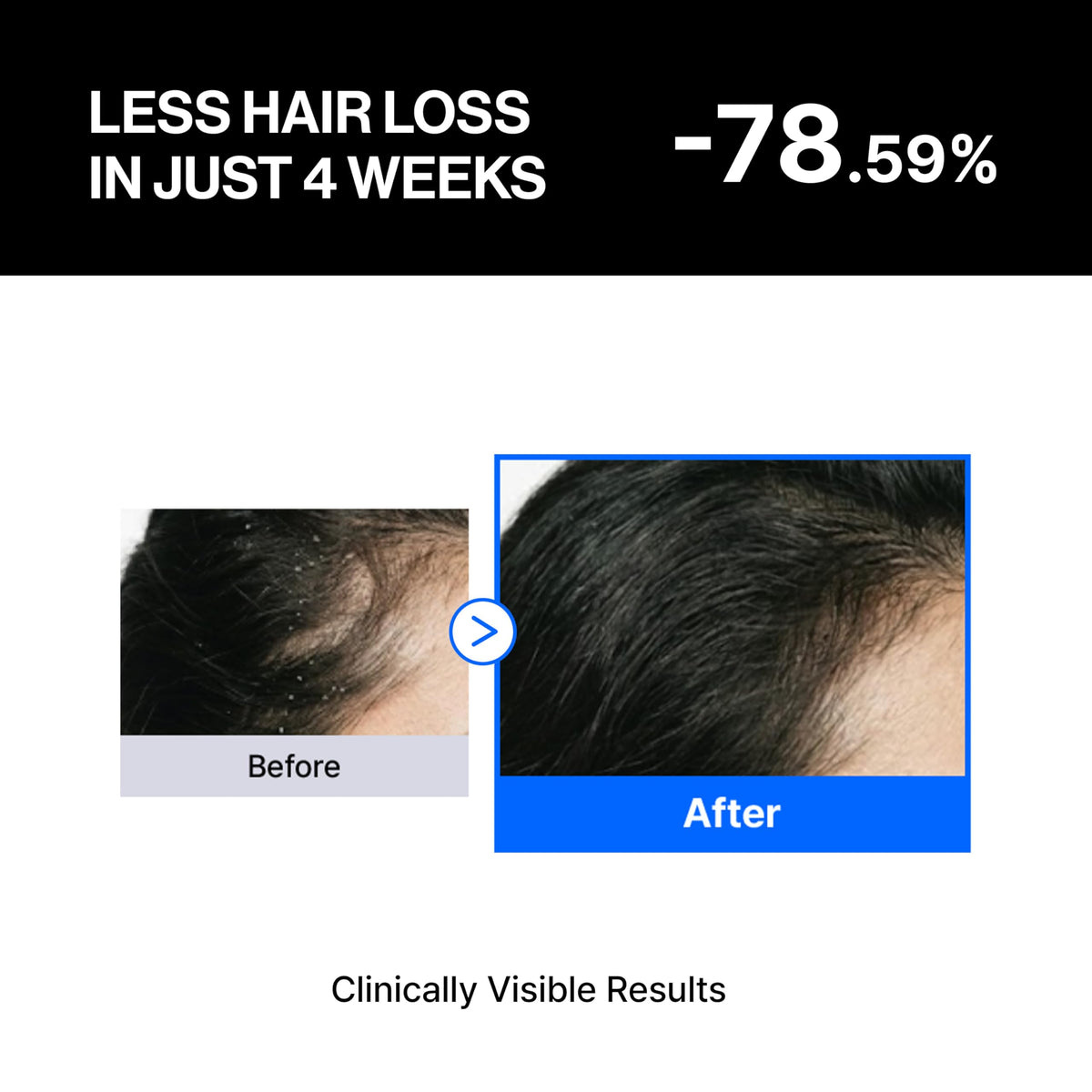 Refilled applicator closeup demonstrating precise scalp delivery