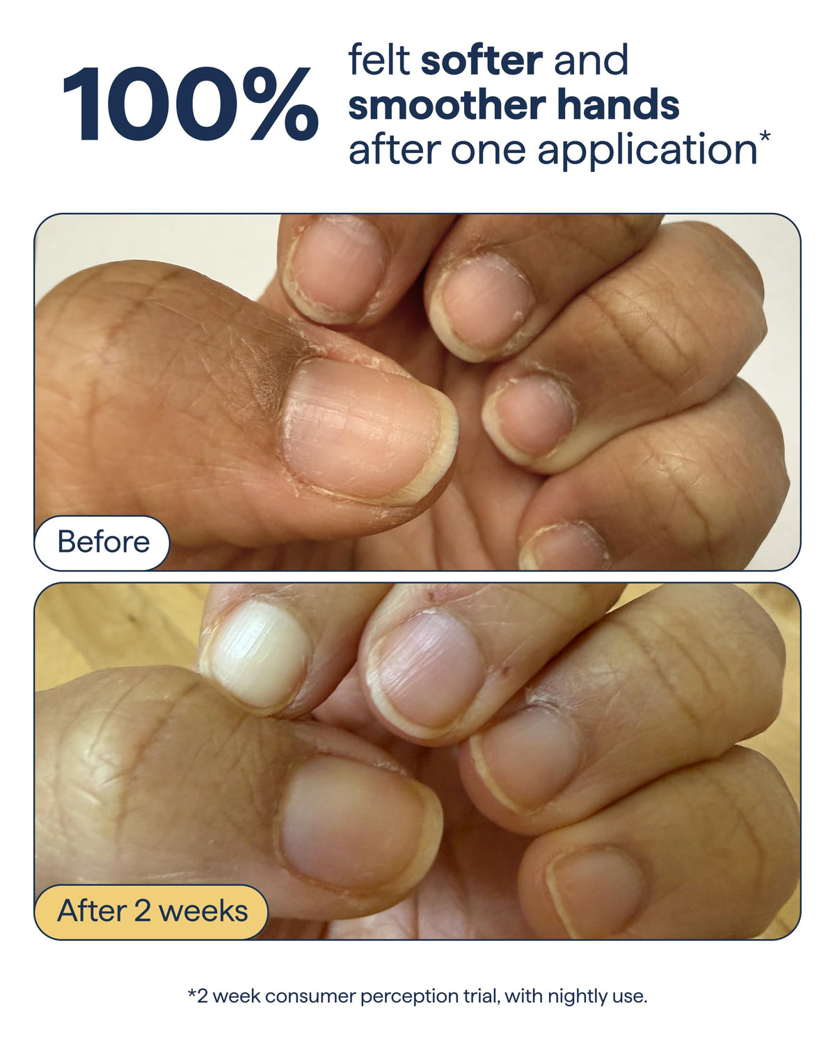 Remedy application on hands in use demonstrating non-greasy hydration