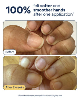 Remedy application on hands in use demonstrating non-greasy hydration