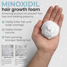 Rida Hair Research Institute Remixidil being applied to scalp for targeted follicle delivery
