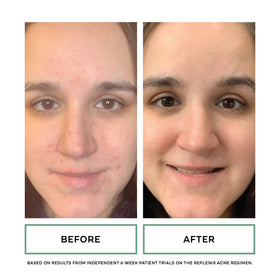 Replenix cleanser dispensed in hand, demonstrates easy application and mild lather