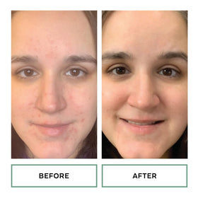 replenix label close-up highlighting 10% glycolic and 2% salicylic