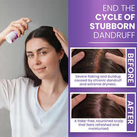 Rida Neoketramin scalp application in use, demonstrates targeted relief and comfort