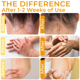 Rida Hair Research Institute being applied to scalp to reduce flaking