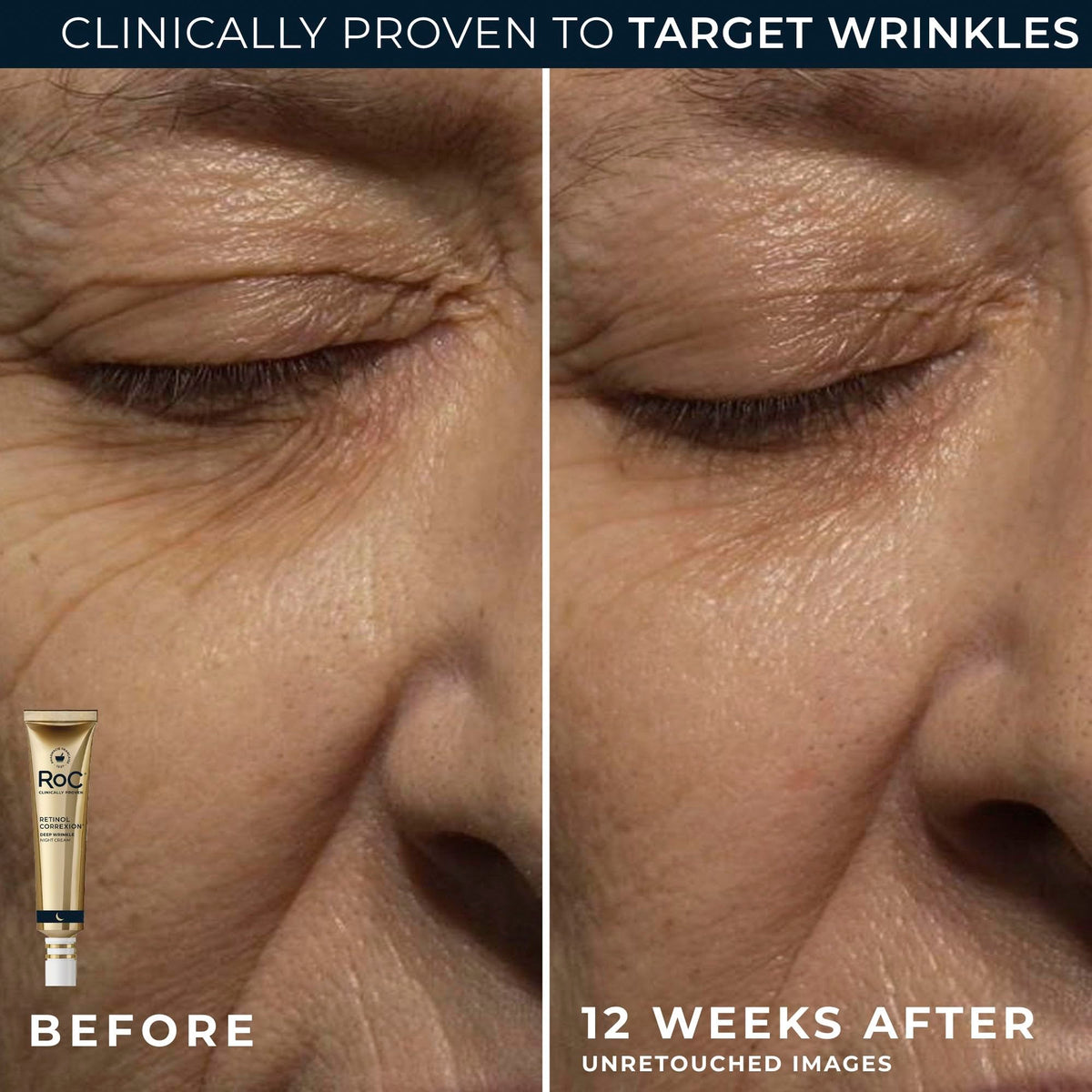 RoC eye cream dabbed under eye demonstrating reduced puffiness benefit