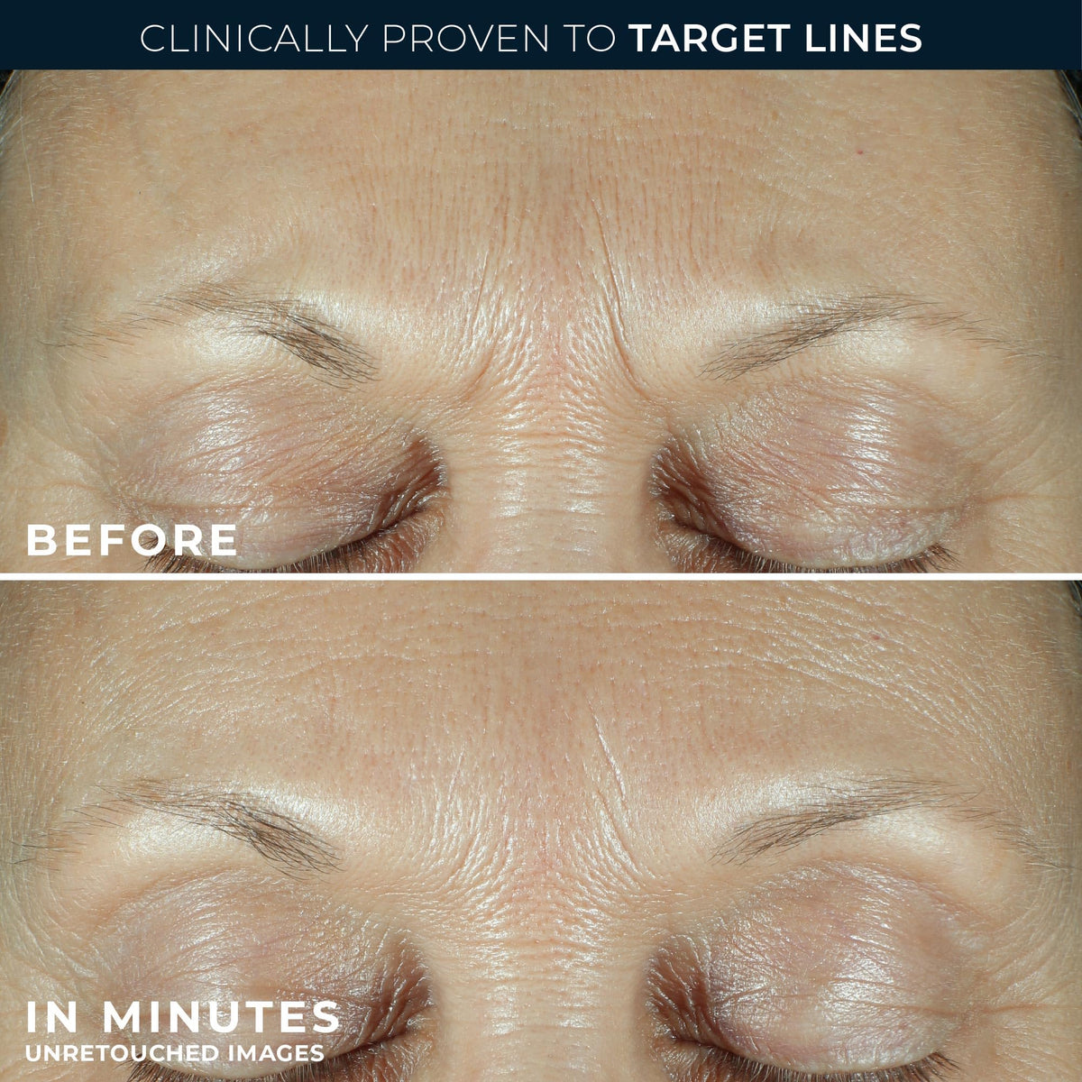 RoC triple hyaluronic acid graphic highlighting multi-level hydration